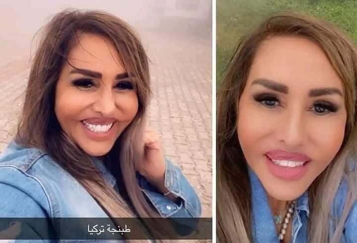 Maha Al-Masri distorted face failed plastic surgery unsuccessful filler shocking