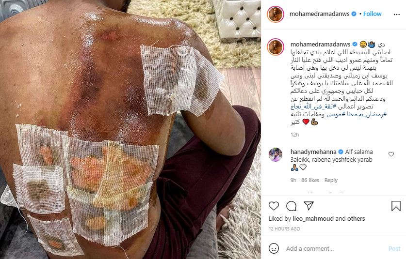 إصابة ظهر حرق حريق متفجرات محمد رمضان mohamed ramadan back injury