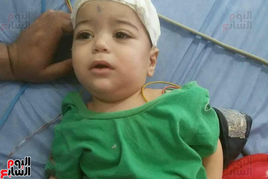استخراج سيخ حديد من جمجمة طفل في مصر.