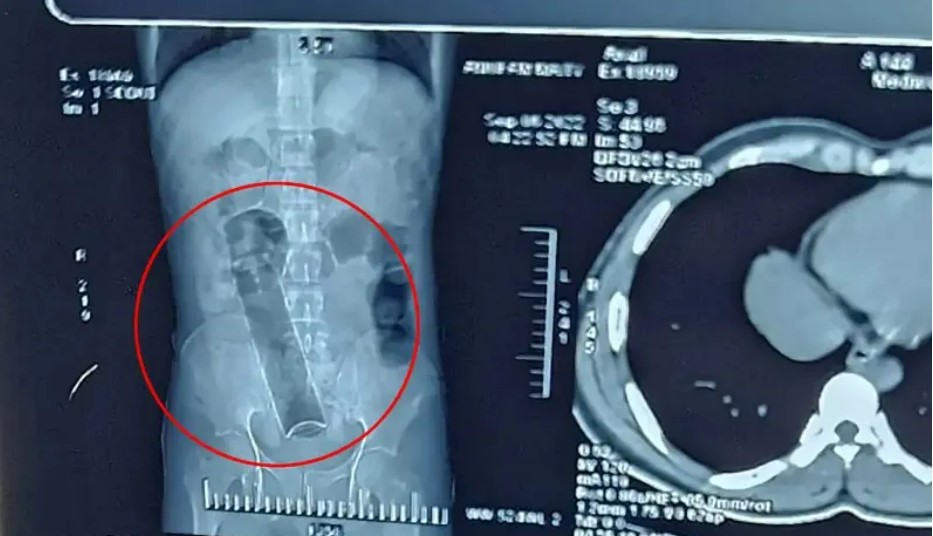 "مزيل عرق في أمعاء رجل من الهند"