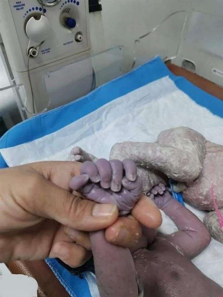 ولادة طفلة عراقية بــ 24 إصبعًا