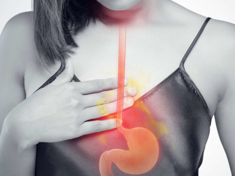 طبيب البوابة: 10 علاجات منزلية لتهدئة حرقة المعدة