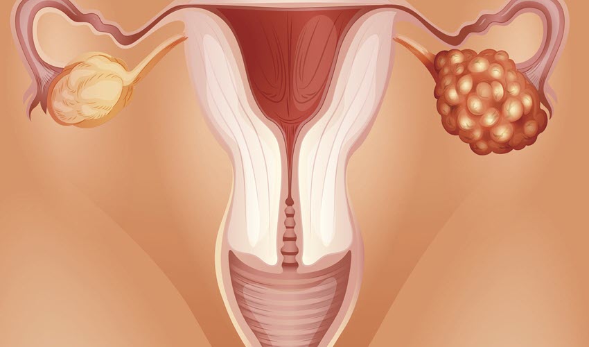 الأسئلة الشائعة حول تكيس المبايض وعلاقته بالكرش