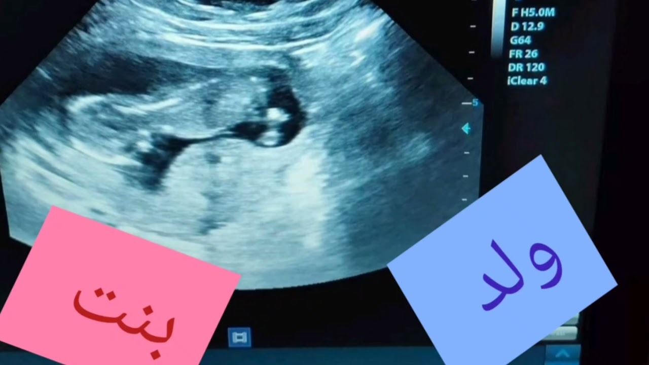 كيف يتم تحديد جنس الجنين؟