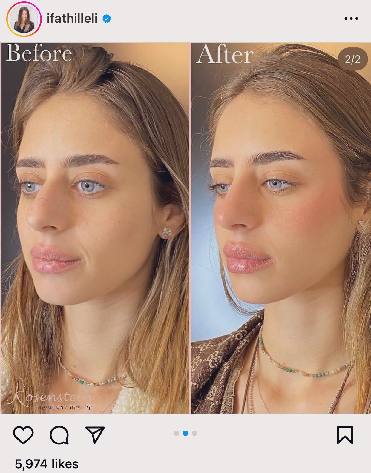 ميا شيم تخضع لعملية تجميل