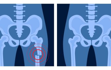 bone glue