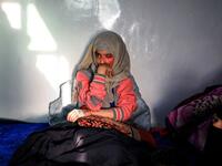 Al-Anoud Hussain Sheryan, a 19-year-old girl disfigured in an acid attack by her abusive husband, sits at a hospital where she is undergoing treatment in Yemen's capital Sanaa on January 28, 2021. Married at the age of 12, rejected at 16, and then disfigured in an acid attack, Sheryan's fate is a shocking illustration of abuse in a society beset by war and poverty. Now aged 19, the young Yemeni woman agreed to relate her ordeal at the hands of her abusive husband -- rare testimony in a country where domesti