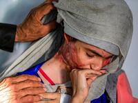 Al-Anoud Hussain Sheryan, a 19-year-old girl disfigured in an acid attack by her abusive husband, sits at a hospital where she is undergoing treatment in Yemen's capital Sanaa on January 28, 2021 as a woman unwraps her veil to show her injuries. Married at the age of 12, rejected at 16, and then disfigured in an acid attack, Sheryan's fate is a shocking illustration of abuse in a society beset by war and poverty. Now aged 19, the young Yemeni woman agreed to relate her ordeal at the hands of her abusive hus