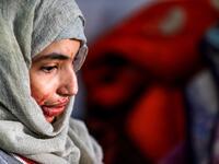 Al-Anoud Hussain Sheryan, a 19-year-old girl disfigured in an acid attack by her abusive husband, sits at a hospital where she is undergoing treatment in Yemen's capital Sanaa on January 28, 2021. Married at the age of 12, rejected at 16, and then disfigured in an acid attack, Sheryan's fate is a shocking illustration of abuse in a society beset by war and poverty. Now aged 19, the young Yemeni woman agreed to relate her ordeal at the hands of her abusive husband -- rare testimony in a country where domesti