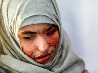 Al-Anoud Hussain Sheryan, a 19-year-old girl disfigured in an acid attack by her abusive husband, sits at a hospital where she is undergoing treatment in Yemen's capital Sanaa on January 28, 2021. Married at the age of 12, rejected at 16, and then disfigured in an acid attack, Sheryan's fate is a shocking illustration of abuse in a society beset by war and poverty. Now aged 19, the young Yemeni woman agreed to relate her ordeal at the hands of her abusive husband -- rare testimony in a country where domesti