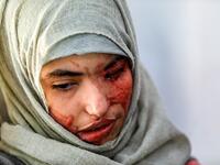 Al-Anoud Hussain Sheryan, a 19-year-old girl disfigured in an acid attack by her abusive husband, sits at a hospital where she is undergoing treatment in Yemen's capital Sanaa on January 28, 2021. Married at the age of 12, rejected at 16, and then disfigured in an acid attack, Sheryan's fate is a shocking illustration of abuse in a society beset by war and poverty. Now aged 19, the young Yemeni woman agreed to relate her ordeal at the hands of her abusive husband -- rare testimony in a country where domesti