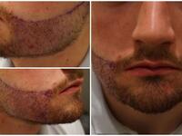 beard transplant
