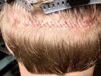 hair transplant