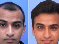 hair transplant