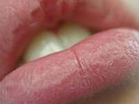 Fal'ha split lip