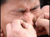 Bee sting facial