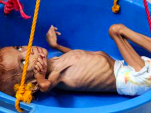 Malnutrition in Yemen is rife (AFP/File Photo) 