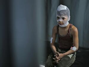 A wounded Syrian child sits at a makeshift clinic in the town of Maaret Misrin following Syrian government forces airstrikes on March 5, 2020 in the country's northwestern Idlib province. Russian air strikes killed at least 15 civilians including a child in the last major opposition bastion of Idlib in northwestern Syria, a Britain-based war monitor said.  Aref TAMMAWI / AFP