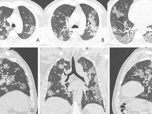 Shocking X-ray images show what coronavirus does to victims' lungs (Twitter)