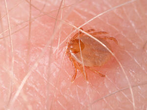 Maculosa fever tick drinking blood biting human skin - Typhoid typhus  (Shutterstock)	