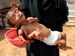 Hashem Mahmoud Atin, a ten-month-old displaced Yemeni child suffering from acute malnutrition and who is unable to reach a hospital for treatment, is held by his mother at a camp in Abs in northern Yemen's Hajjah province on September 3, 2020. Hundreds of children and pregnant women have been negatively affected by the closure of medical clinics funded by the United Nations Children's Fund (UNICEF) in Yemen's displaced camps. ESSA AHMED / AFP