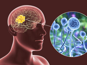 Black fungus cases suspected in Egypt