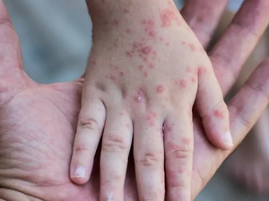 ظهرت معظم الحالات في أوروبا وليس في دول وسط وغرب أفريقيا حيث يتوطن الفيروس