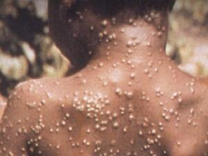 جدري القردة