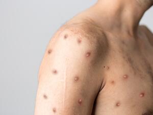 Monkeypox cases