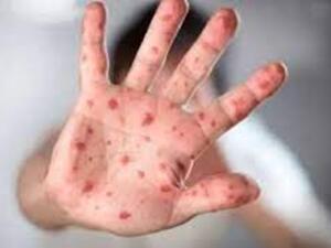 جدري القرود