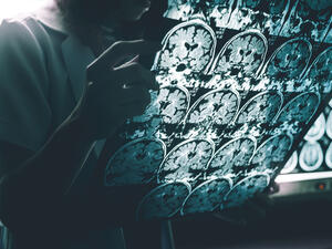 Alzheimer's disease