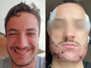 انتحار شاب فرنسي بعد فشل عملية زراعة اللحية