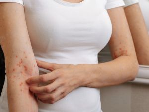 مرض الجرب: الأنواع، الأعراض، المضاعفات، طرق العلاج