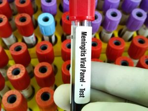 التهاب السحايا: الأعراض، المضاعفات، طرق الوقاية