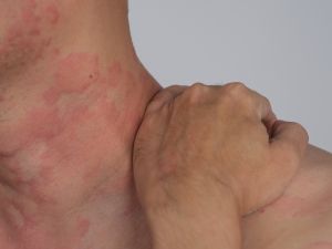 حساسية الارتكاريا (الشرى): الأسباب، الأعراض، طرق العلاج