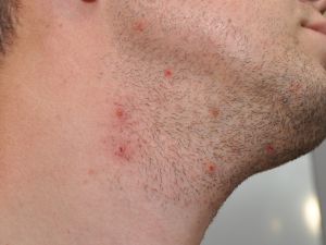 أسباب ظهور الحبوب بعد الحلاقة وطرق التعامل معها