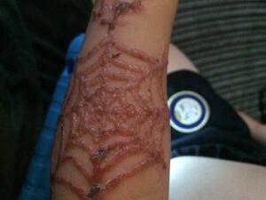 Toni Feeney, of Colne, Lancashire, took to Facebook on Friday cautioning other parents of the dangers of black henna tattoos after her two sons were left with severe chemical burns  (Twitter)
