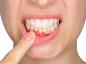 التهابات اللثة قد تساهم في الإصابة بالسرطان 