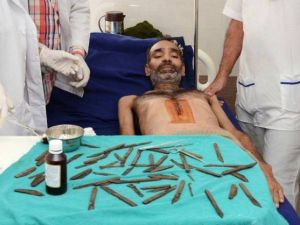 شرطي هندي ابتلع 40 سكينا خلال شهرين