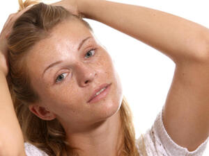 ودعي النمش بهذه الوصفة الطبيعية...