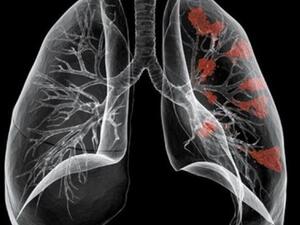 الثوم ربما يشكل عامل حماية ضد سرطان الرئة.