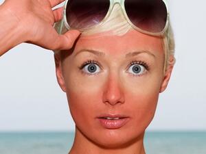 طرق فعالة لعلاج وشفاء مشاكل البشرة التي تعرضت لحروق الشمس