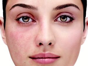 يمكن أن تؤثر الوردية أيضا على المناطق المحيطة بالعنق والظهر والصدر