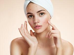 مكونات طبيعية ستساعدك على علاج المشكلة