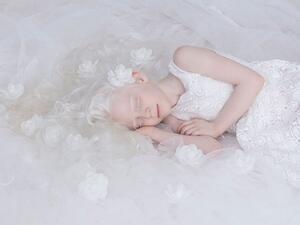 نظرة مختلفة وانسانية للاطفال المصابين باضطراب آلبينو