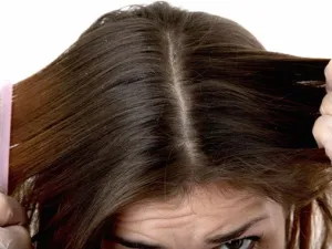 طبيب البوابة: زيت النيم للتخلص من قشرة الرأس