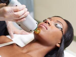 العلاج بالليزر يساعد على التخلص من البثور