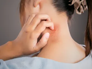 كثيرًا ما نتعرض للدغات أو عضات البعوض خصوصاً في فصل الصيف