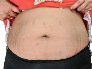 تشققات الحمل لا بدّ منه عند بعض النساء الأمر يعود إلى طبيعة الأجسام

