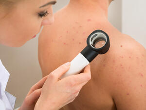 جرّبي شرائح الأناناس على البثور التي تزعجكِ في منطقة الظهر

